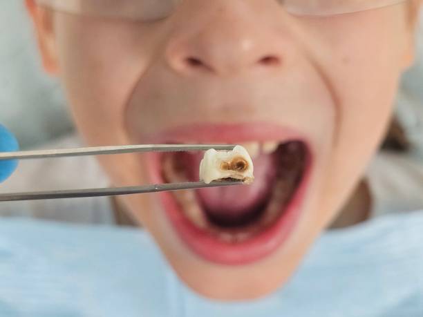 Best Broken or Cracked Tooth Emergency Dentist in Brass Castle, NJ